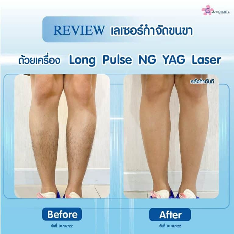 รีวิวเลเซอร์ขนขาที่ Gangnam Clinic