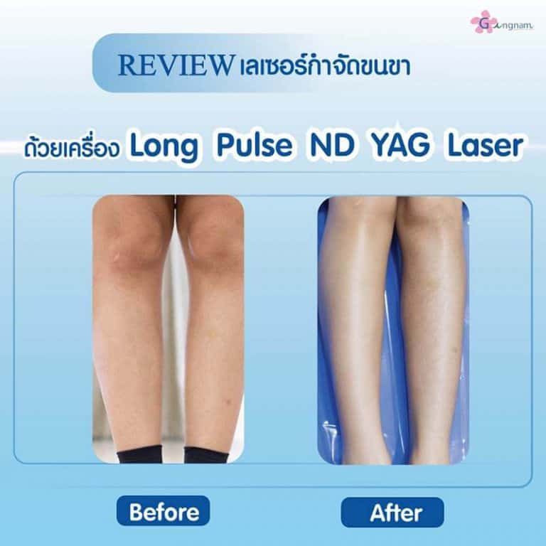 รีวิวเลเซอร์ขนขาที่ Gangnam Clinic