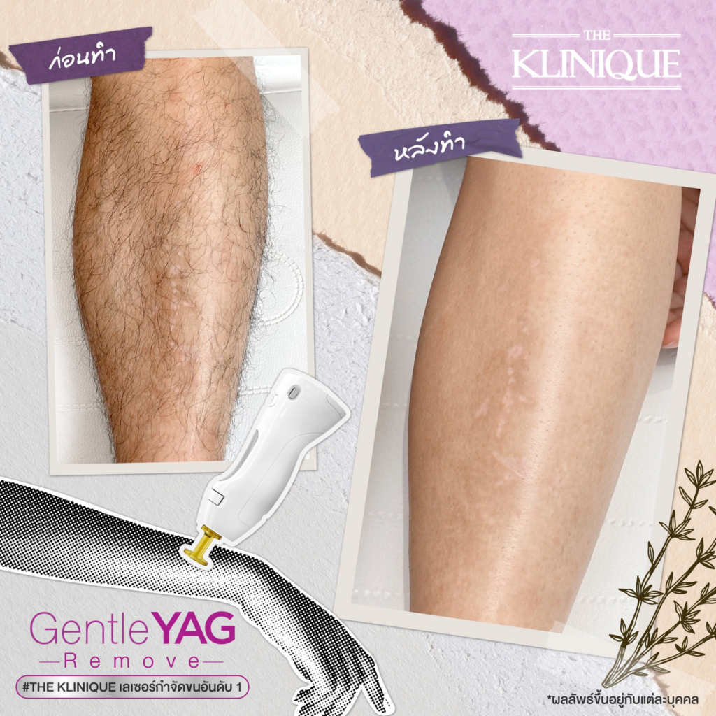 รีวิวเลเซอร์ขนขาที่ The Klinique