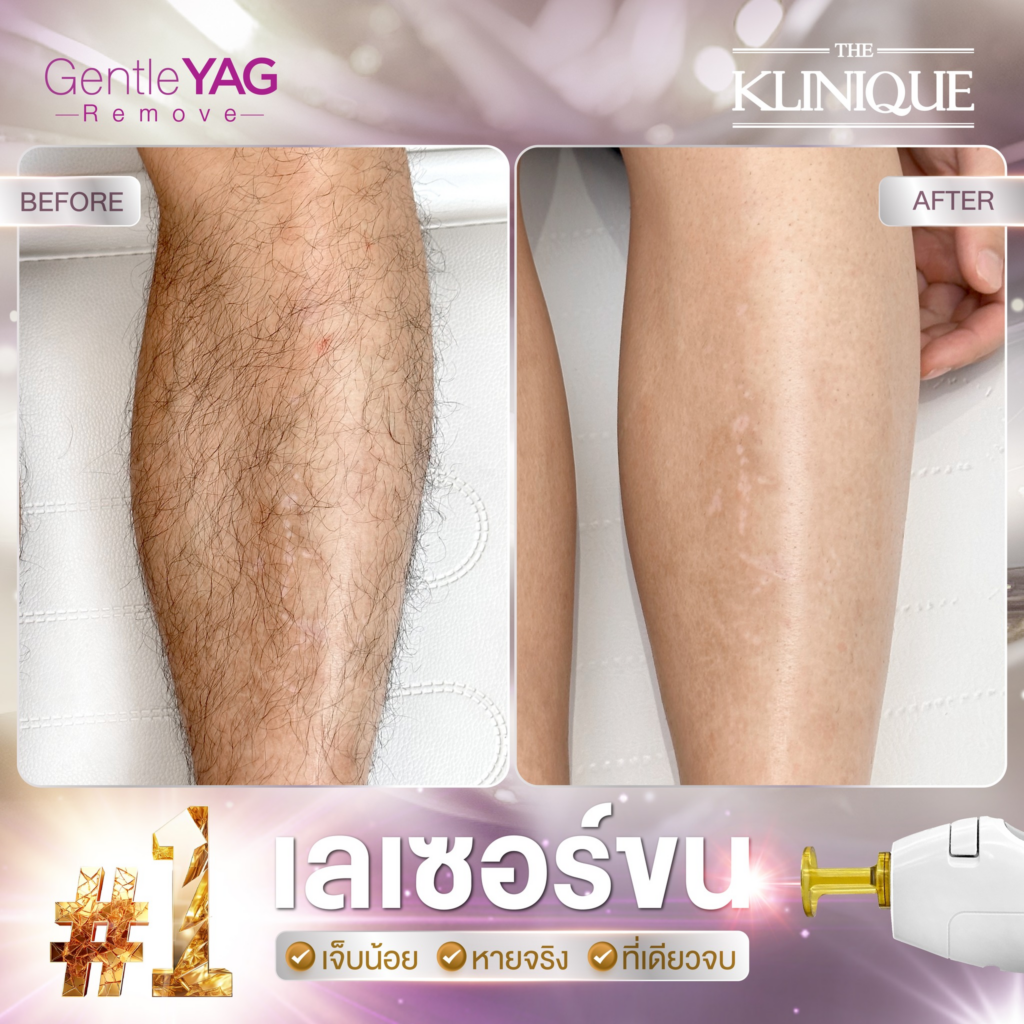 รีวิวเลเซอร์ขนขาที่ The Klinique