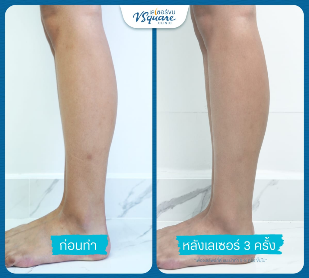 รีวิวเลเซอร์ขนขาที่ V Square Clinic