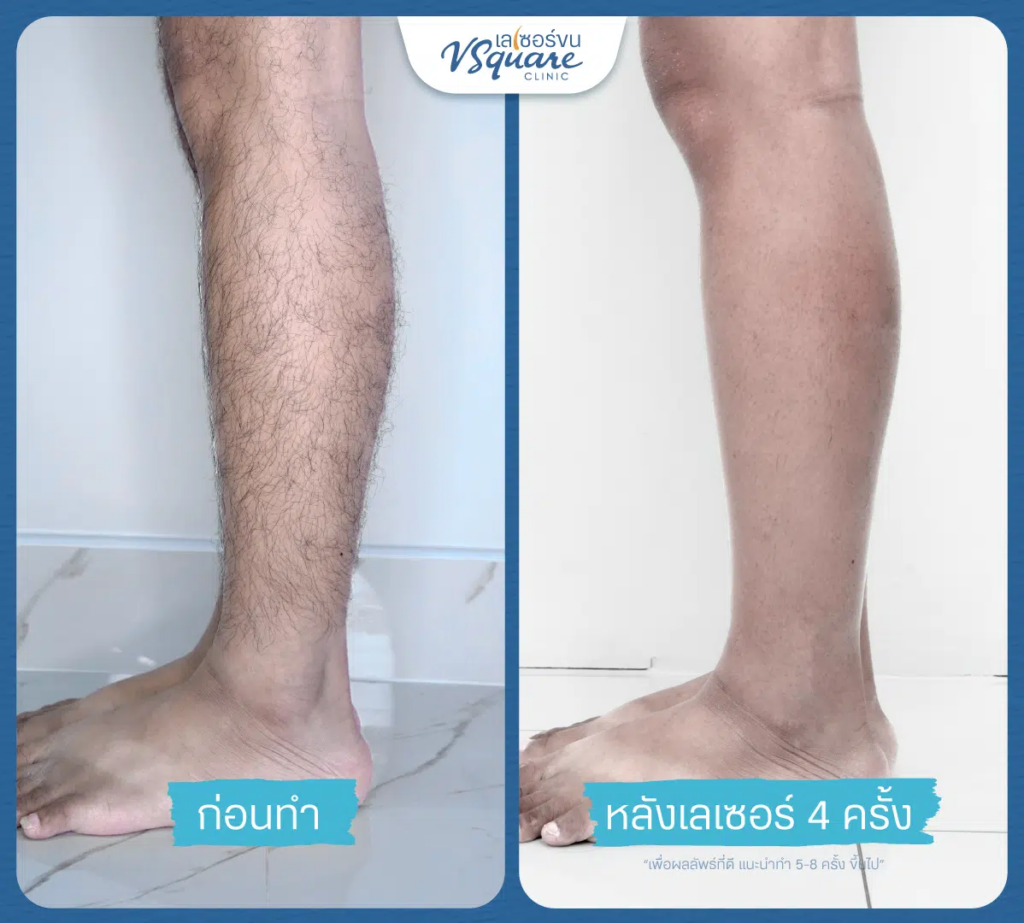 รีวิวเลเซอร์ขนขาที่ V Square Clinic