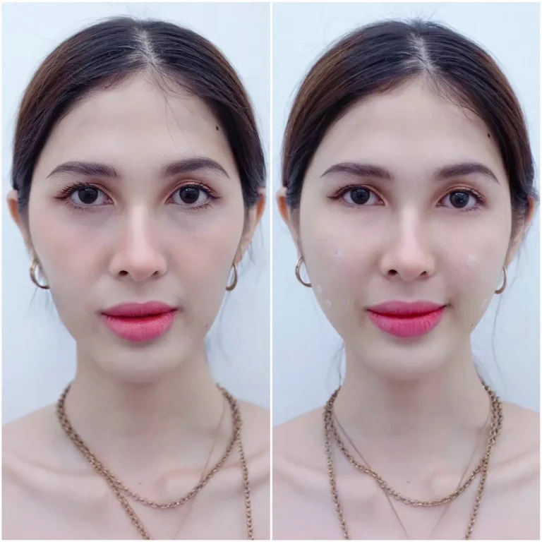 รีวิวฉีดฟิลเลอร์ใต้ตาที่ LBC Clinic