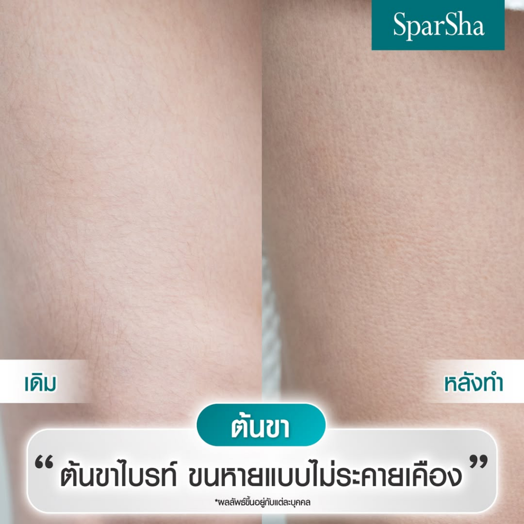 รีวิวเลเซอร์ขนขาที่ Sparsha