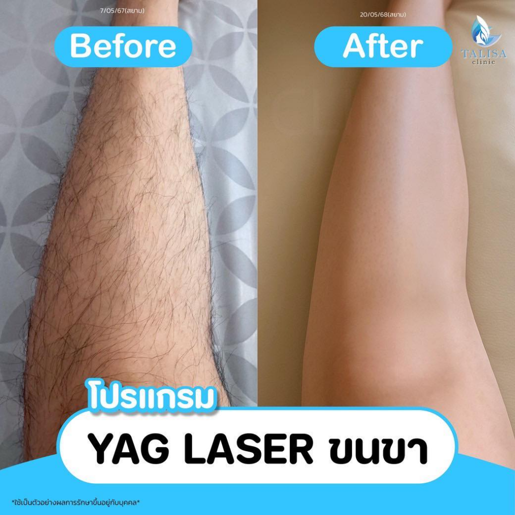 รีวิวเลเซอร์ขนขาที่ TALISA Clinic