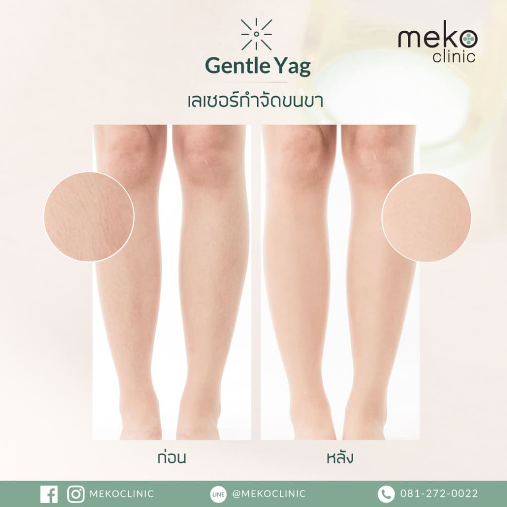 รีวิวเลเซอร์ขนขาที่ Meko Clinic