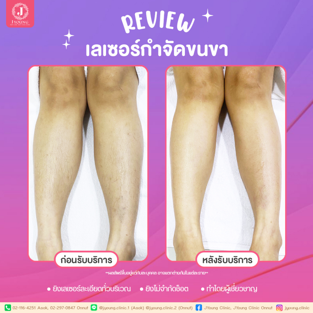 รีวิวเลเซอร์ขนขาที่ J Young Clinic
