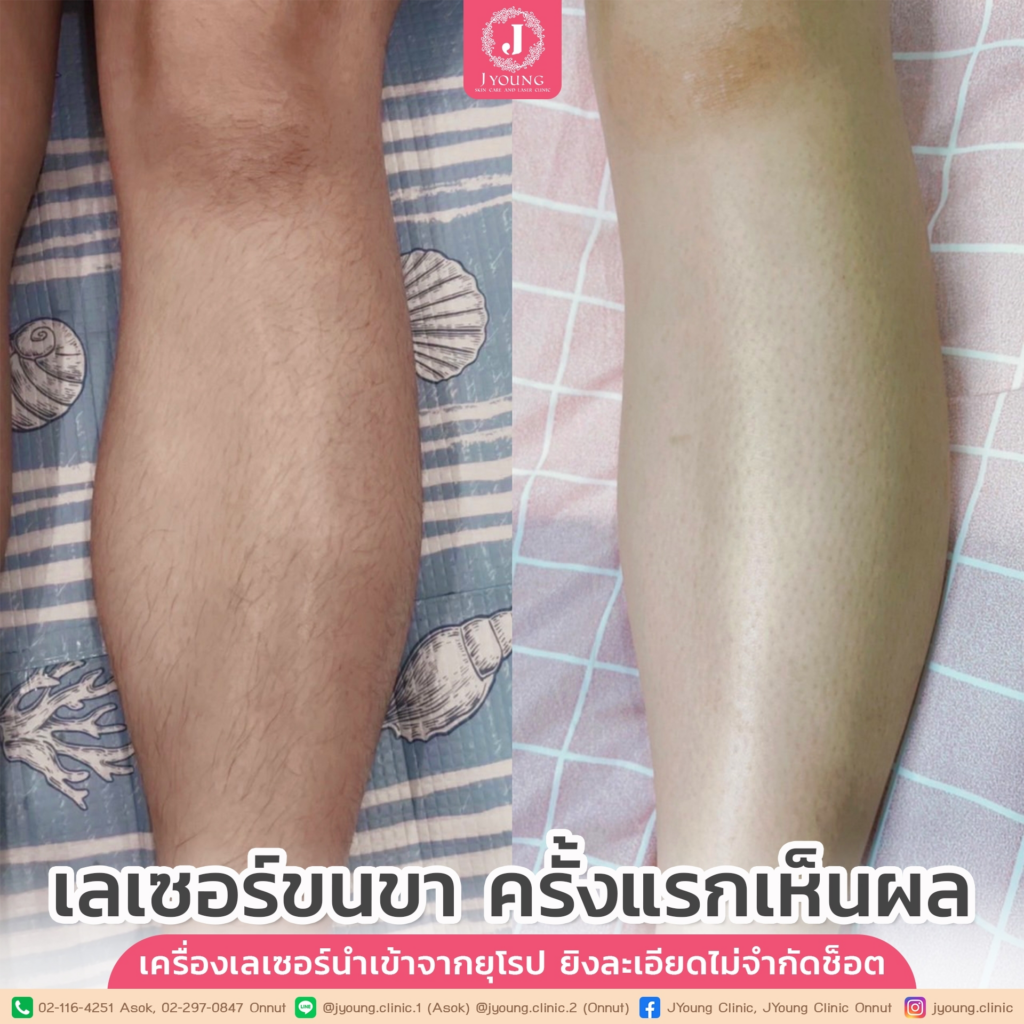 รีวิวเลเซอร์ขนขาที่ J Young Clinic