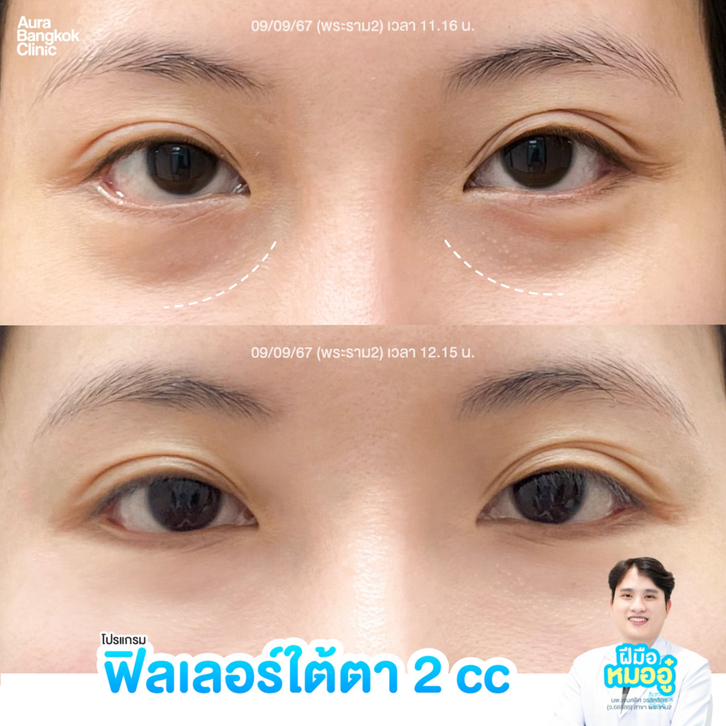 รีวิวฉีดฟิลเลอร์ใต้ตาที่ Aura Bangkok Clinic