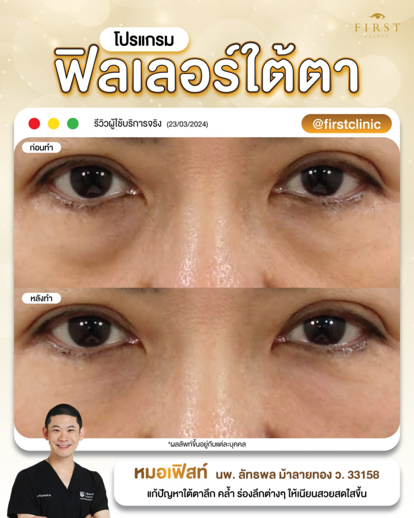 รีวิวฉีดฟิลเลอร์ใต้ตาที่ First Clinic