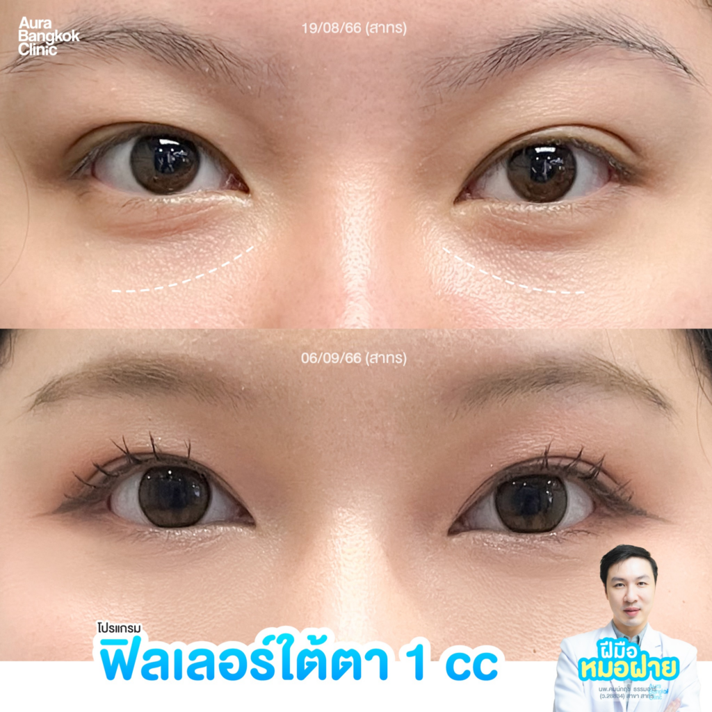 รีวิวฉีดฟิลเลอร์ใต้ตาที่ Aura Bangkok Clinic