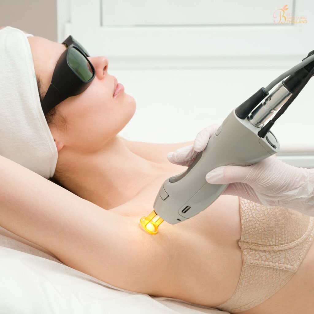 การกำจัดขนรักแร้ด้วยเลเซอร์