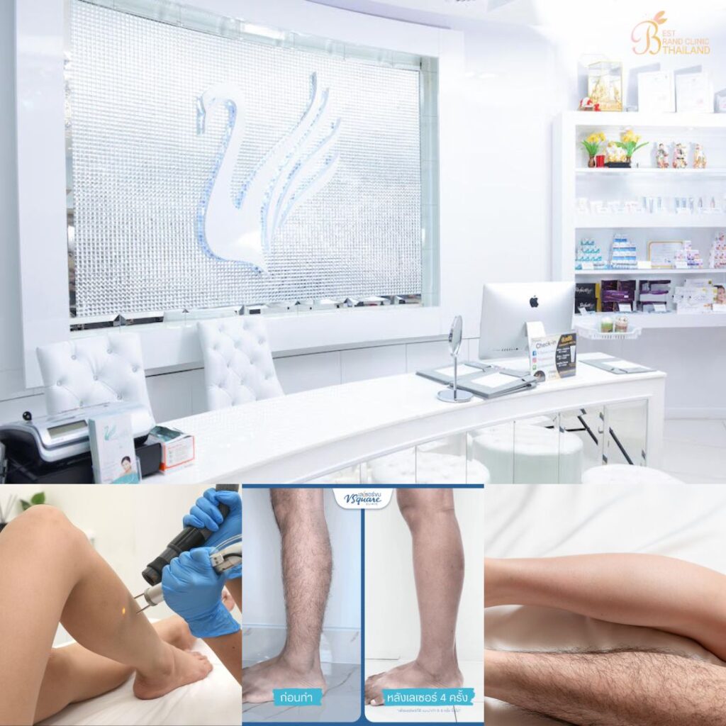 เลเซอร์ขนขาที่ V Square Clinic