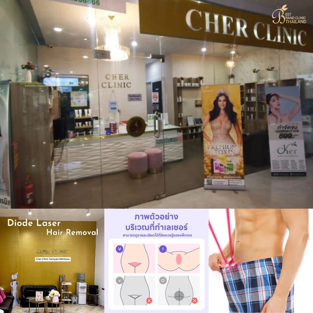 เลเซอร์ขนน้องชายที่ Cher Clinic