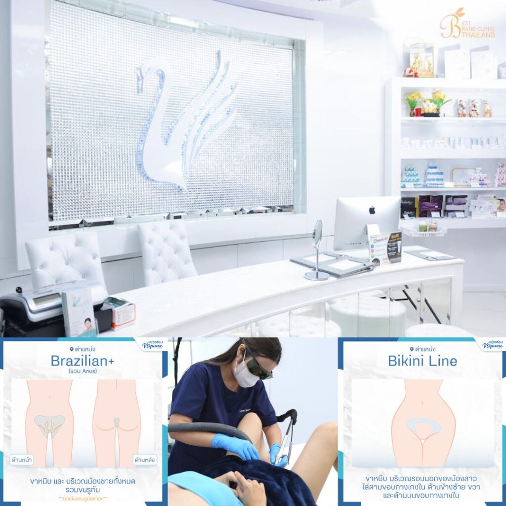 เลเซอร์ขนน้องสาวที่ V Square Clinic