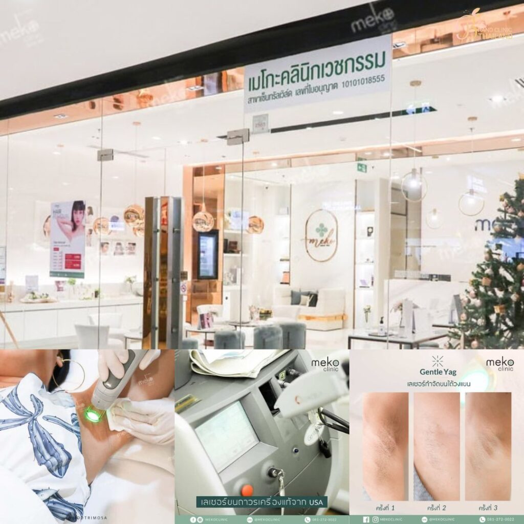 เลเซอร์ขนรักแร้ที่ Meko Clinic