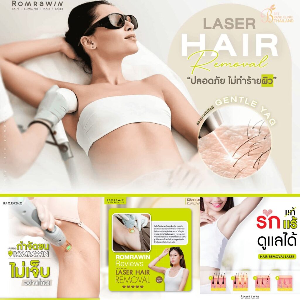 เลเซอร์ขนรักแร้ที่ Romrawin Clinic