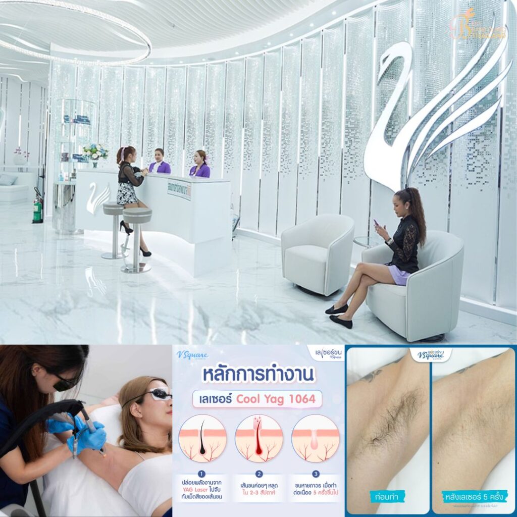 เลเซอร์ขนรักแร้ที่ V Square Clinic