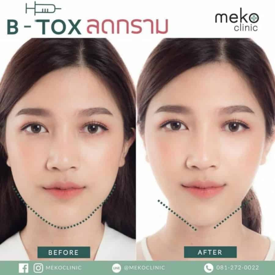 รีวิวฉีดโบท็อกซ์ที่ Meko Clinic