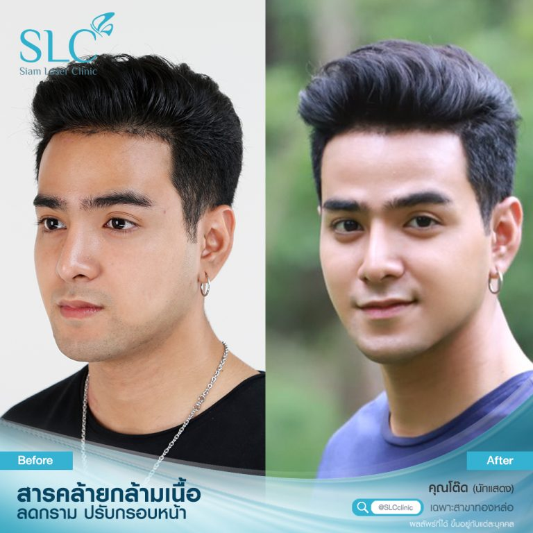 รีวิวฉีดโบท็อกซ์ที่ SLC Clinic