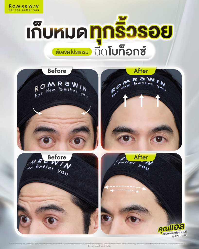 รีวิวฉีดโบท็อกซ์ที่ Romrawin Clinic