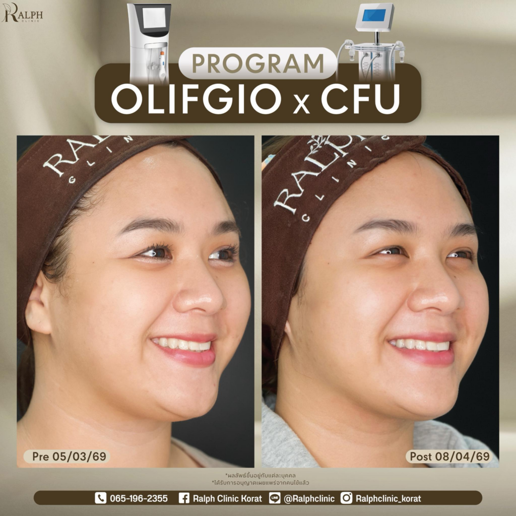 รีวิวคลินิกเสริมความงาม โคราชที่ Ralph Clinic Korat