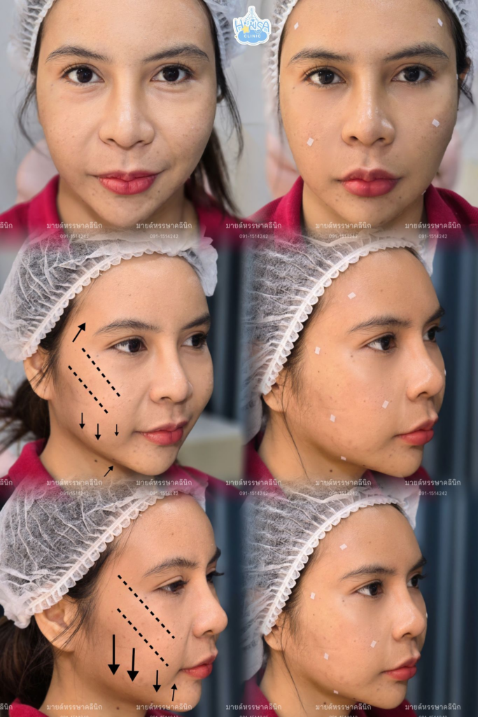 รีวิวคลินิกเสริมความงาม โคราชที่ Hansa Clinic