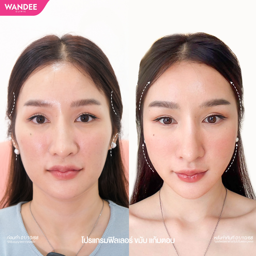 รีวิวคลินิกเสริมความงาม โคราชที่ WANDEE CLINIC