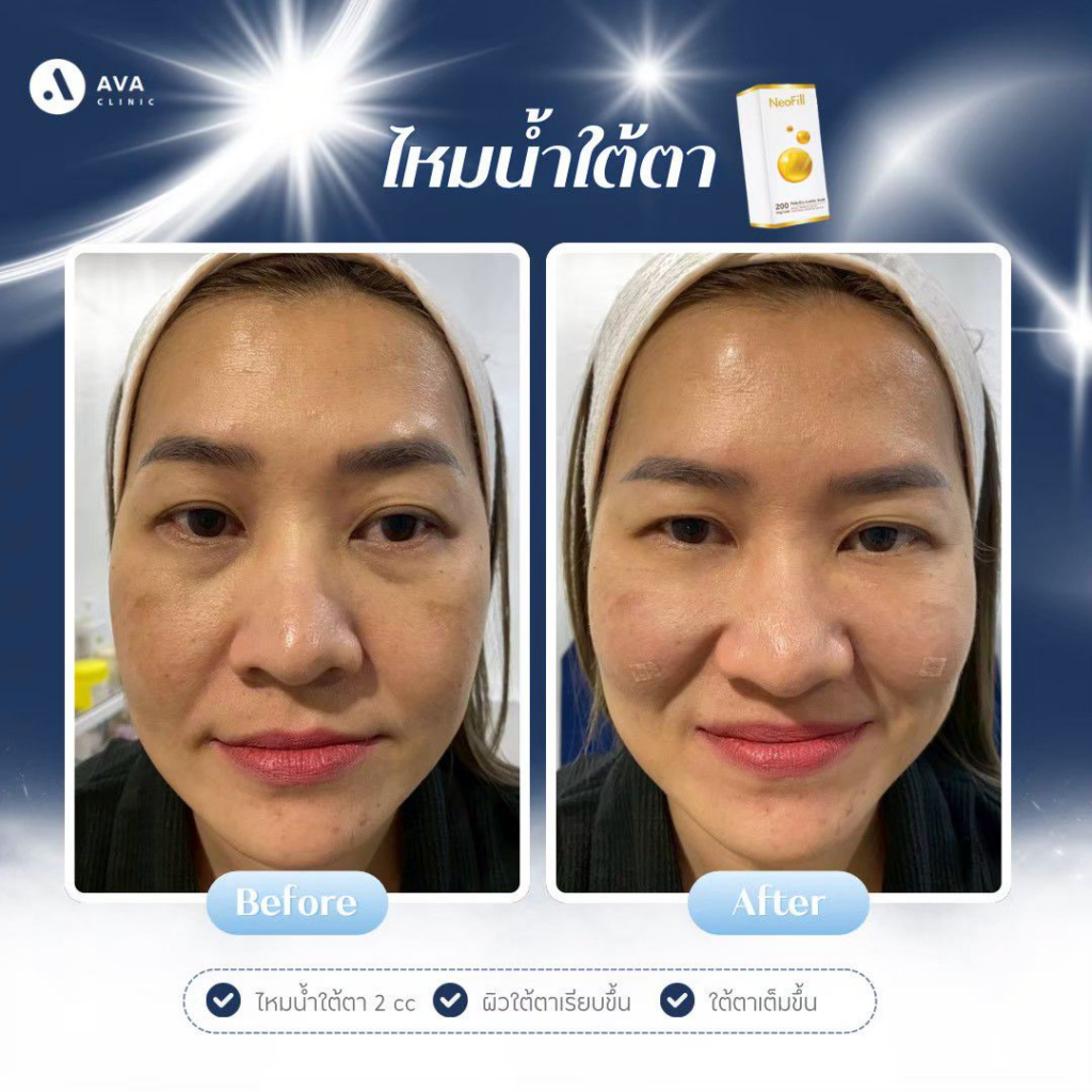 รีวิวคลินิกเสริมความงาม โคราชที่ AVA Clinic