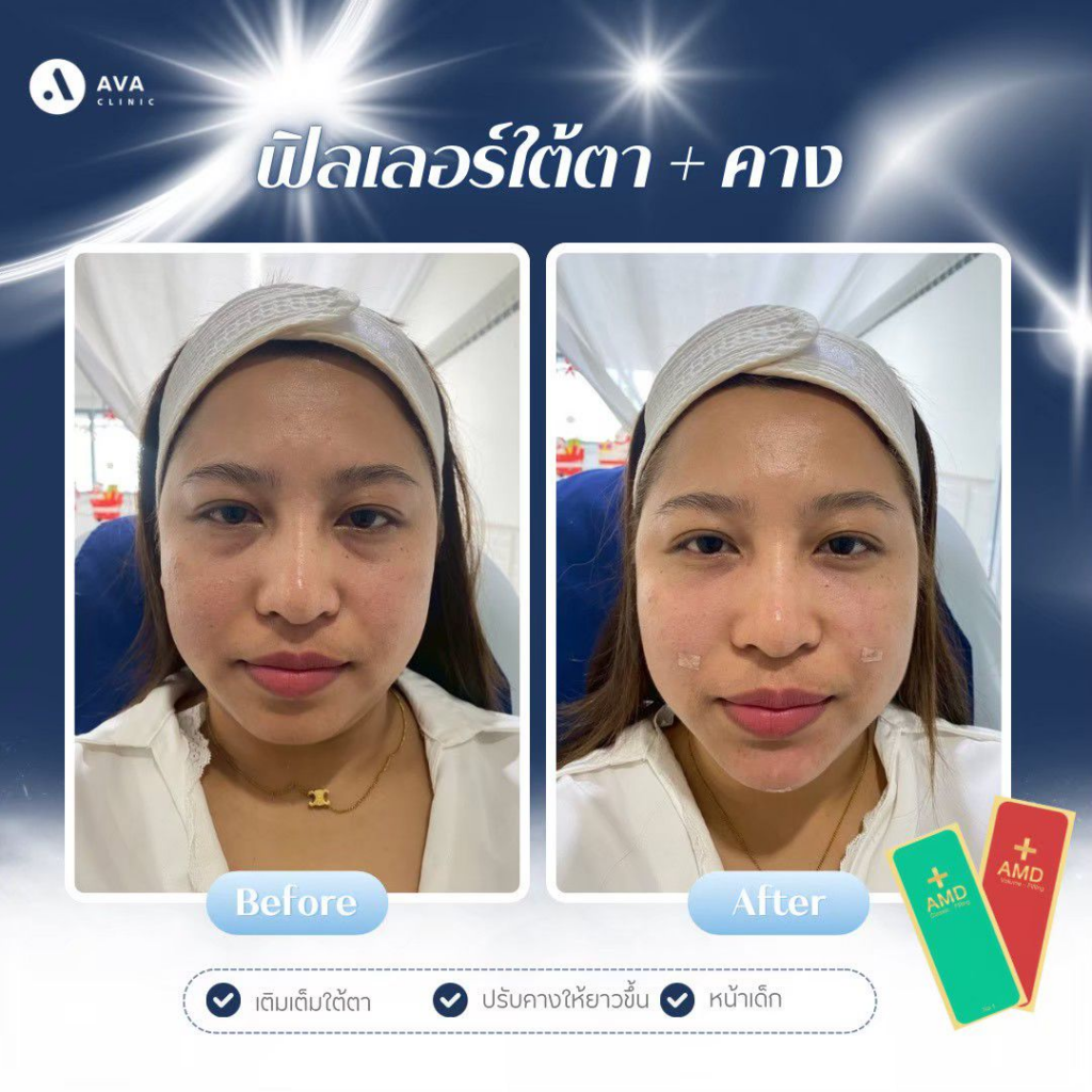 รีวิวคลินิกเสริมความงาม โคราชที่ AVA Clinic