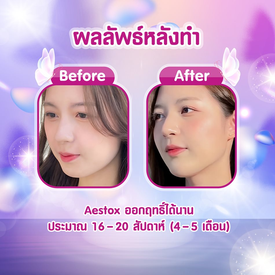 รีวิวฉีดโบท็อกซ์ที่ ราชเทวีคลินิก