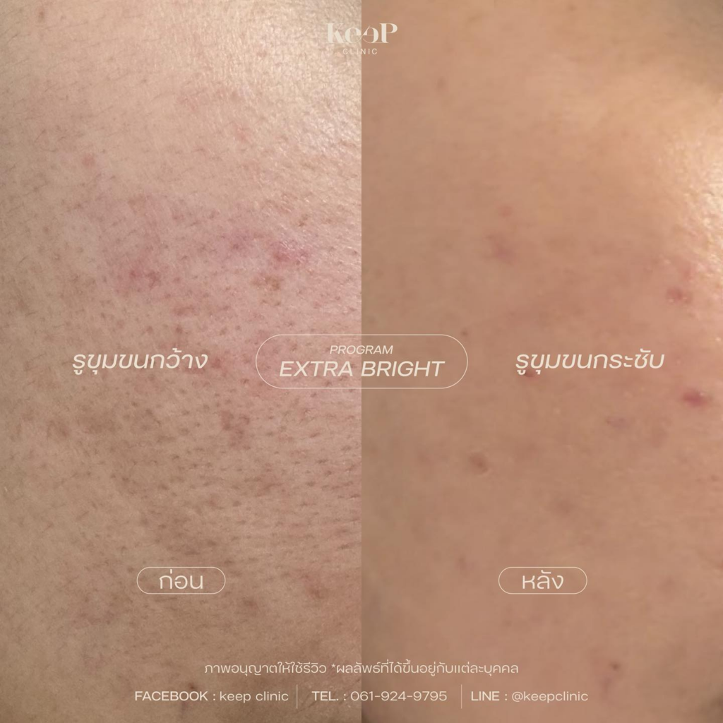 รีวิวคลินิกเสริมความงาม โคราชที่ Keep Clinic