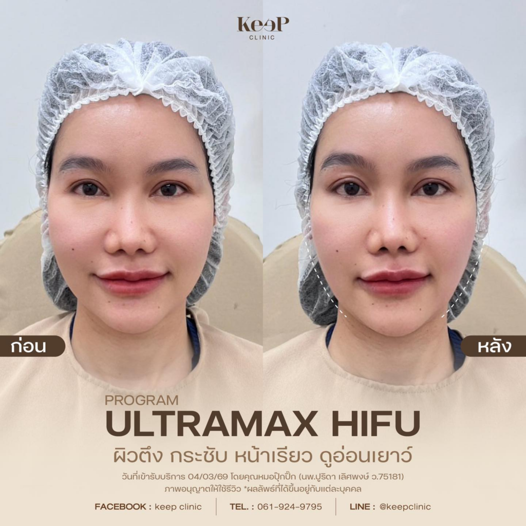 รีวิวคลินิกเสริมความงาม โคราชที่ Keep Clinic