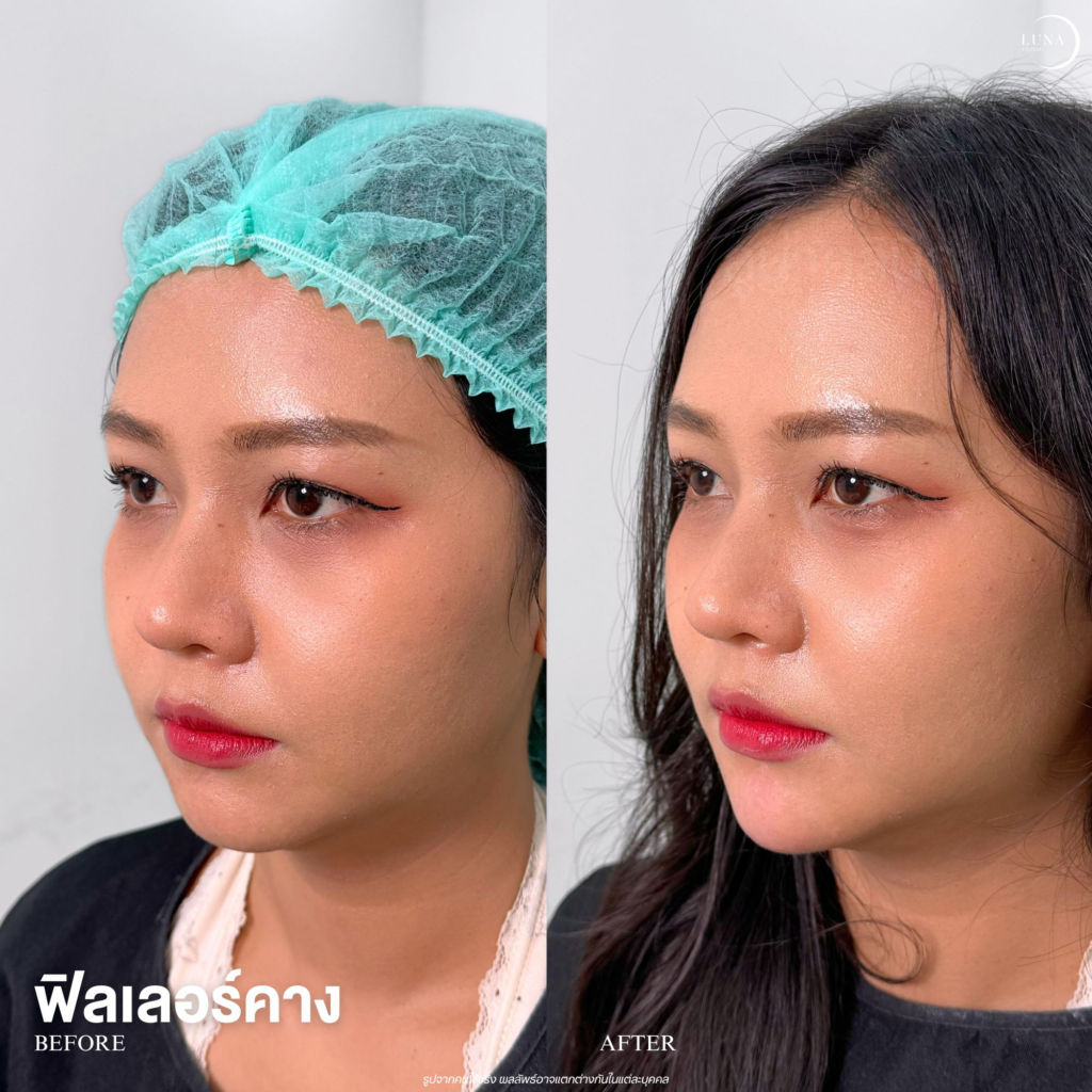 รีวิวคลินิกเสริมความงาม โคราชที่ Luna Clinic 