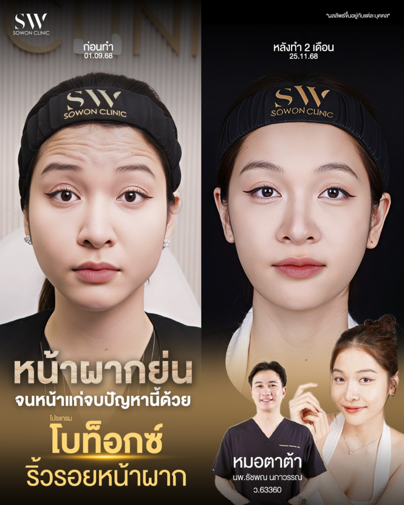 รีวิวฉีดโบท็อกซ์ที่ Sowon Clinic