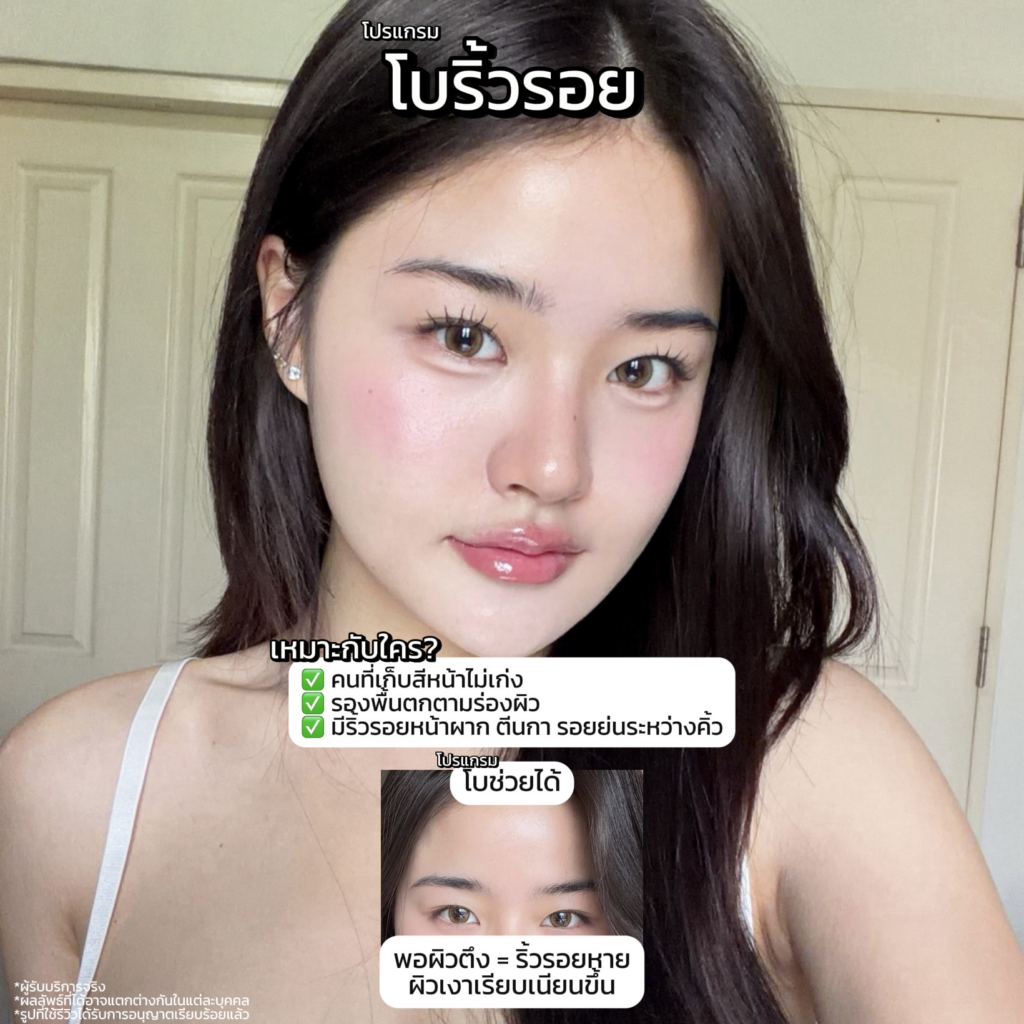 รีวิวฉีดโบท็อกซ์ที่ LBC Clinic