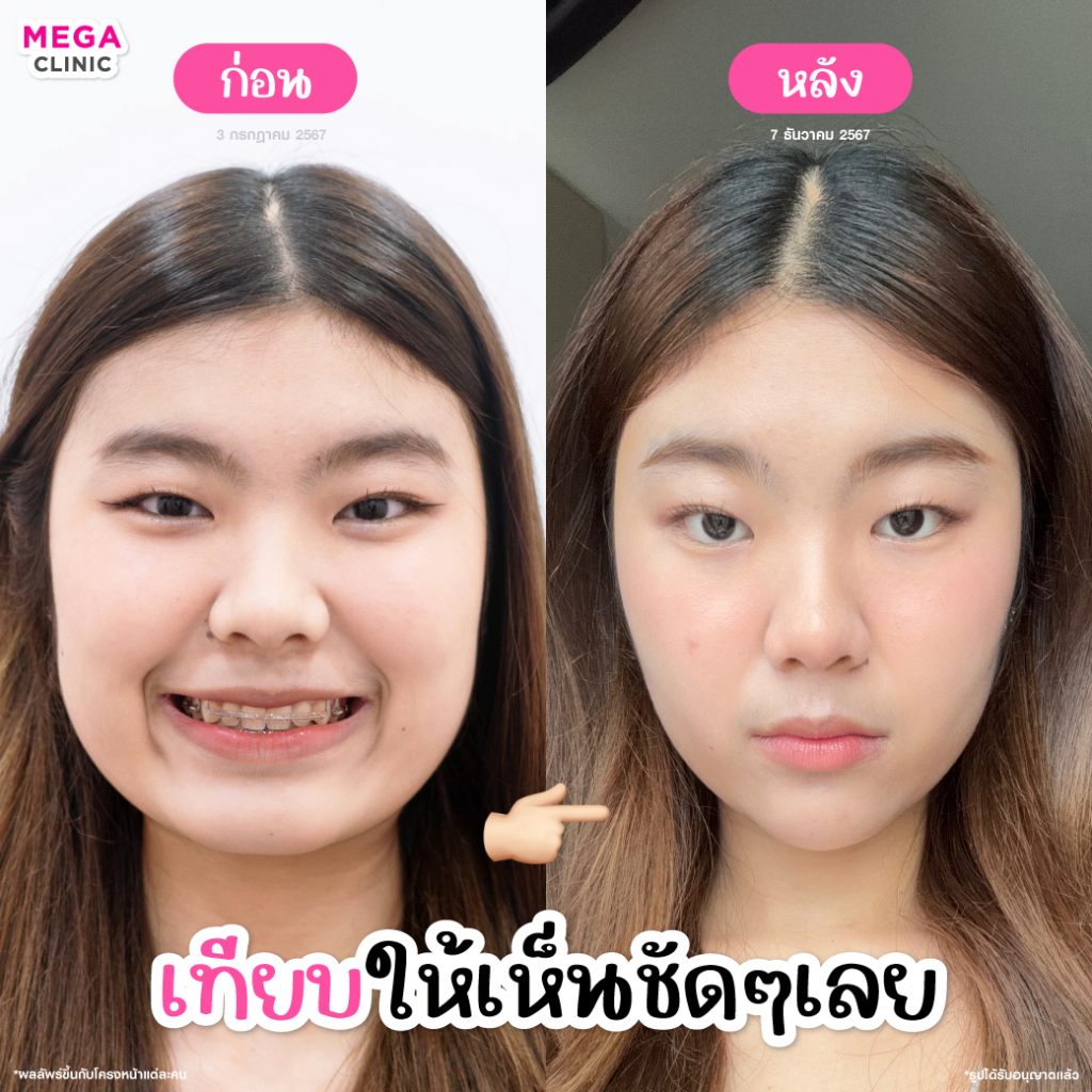 รีวิวฉีดโบท็อกซ์ที่ Mega Clinic