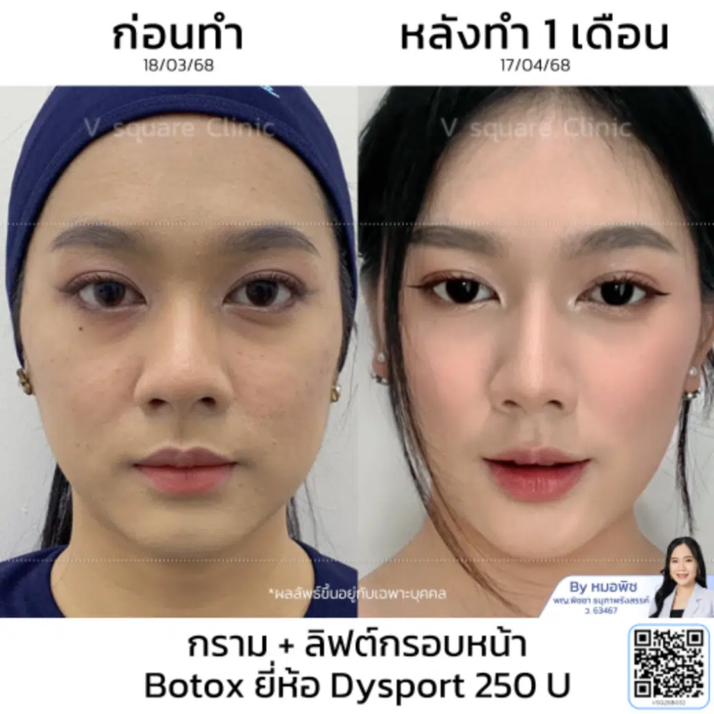 รีวิวฉีดโบท็อกซ์ที่ V Square Clinic