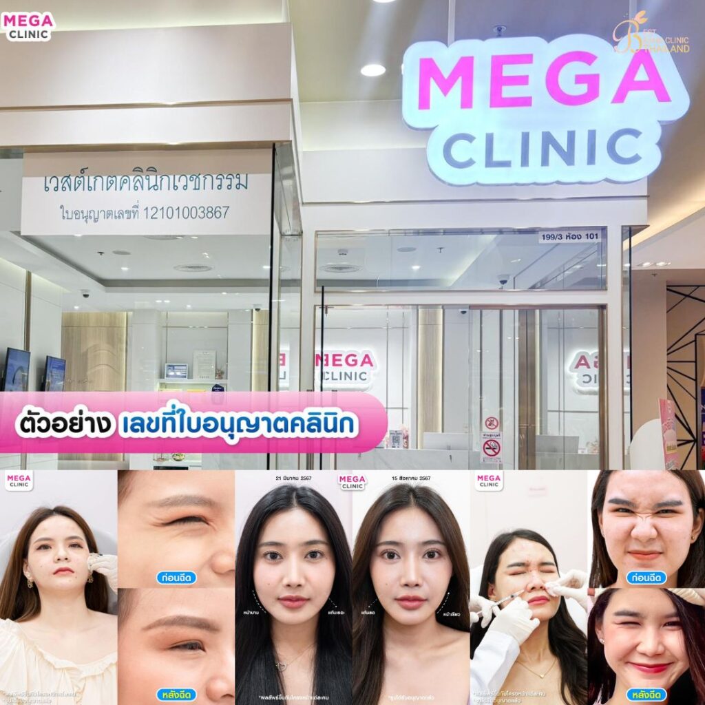 ฉีดโบท็อกซ์ที่ Mega Clinic