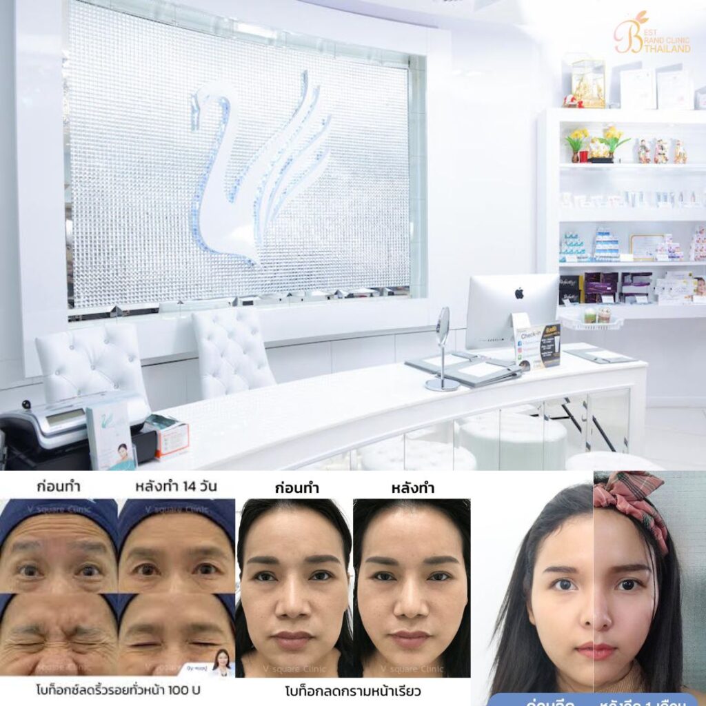 ฉีดโบท็อกซ์ที่ V Square Clinic