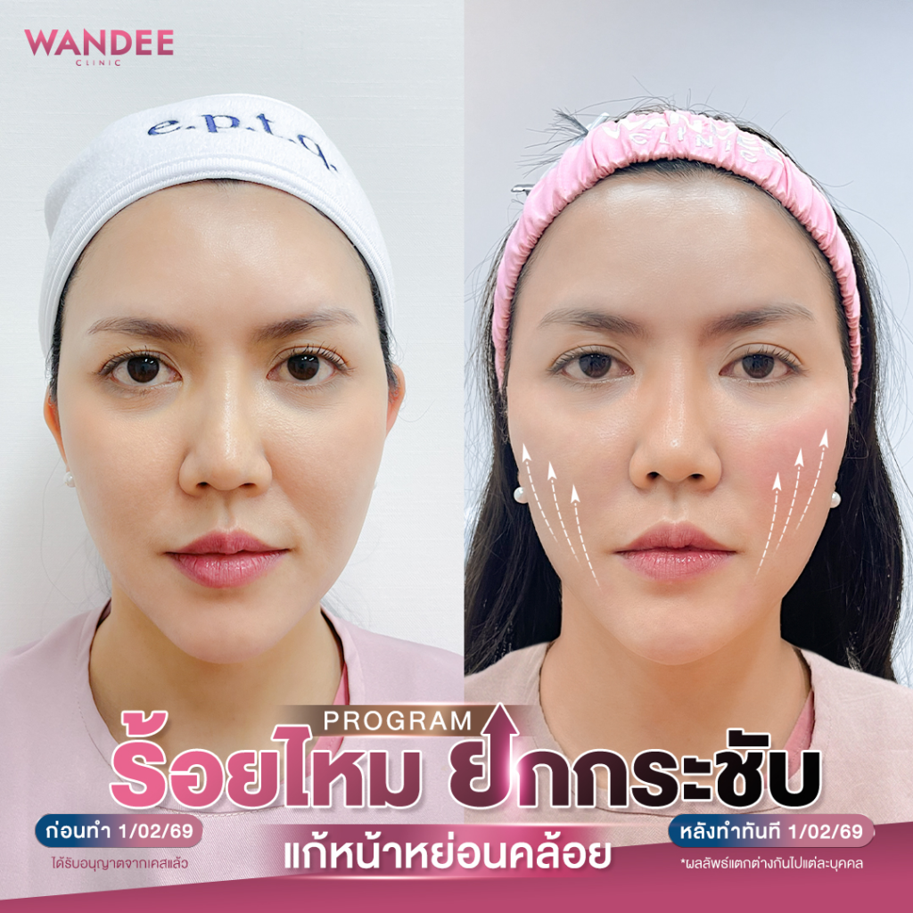 รีวิวคลินิกเสริมความงามขอนแก่นที่ Wandee Clinic