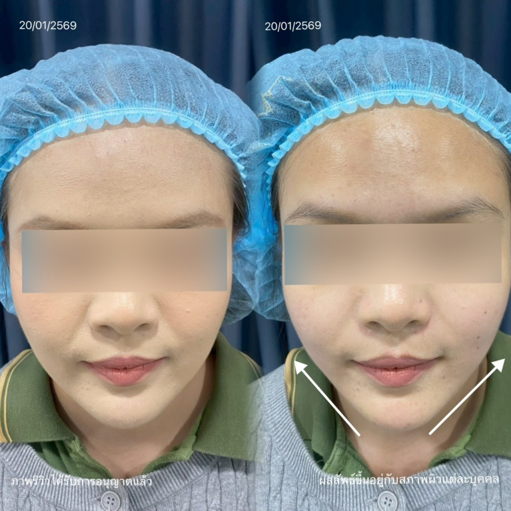 รีวิวคลินิกเสริมความงามขอนแก่นที่ Cloud Clinic