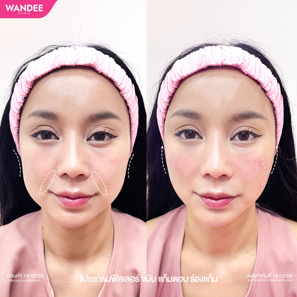 รีวิวคลินิกเสริมความงามขอนแก่นที่ Wandee Clinic