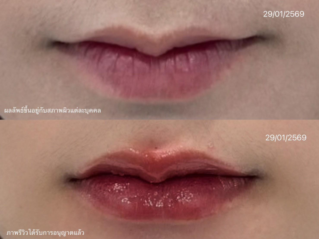 รีวิวคลินิกเสริมความงามขอนแก่นที่ Cloud Clinic