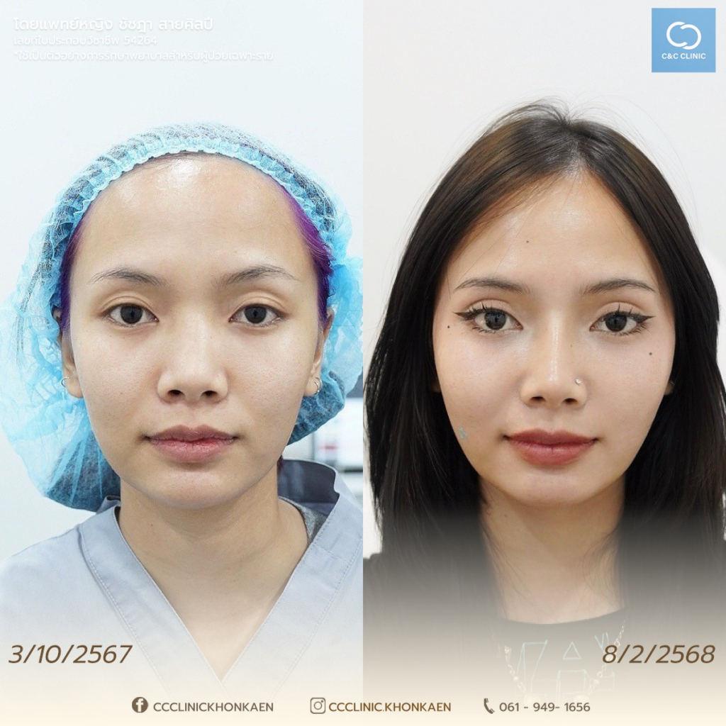 รีวิวคลินิกเสริมความงามขอนแก่นที่ C&C Clinic