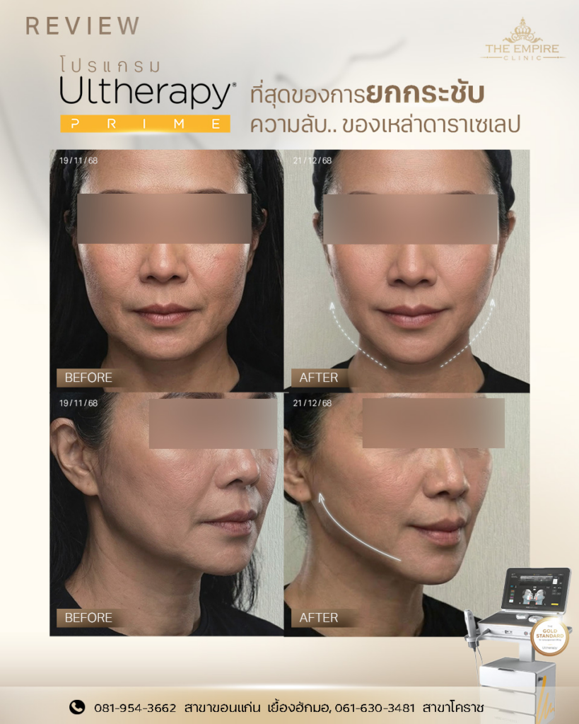 รีวิวคลินิกเสริมความงามขอนแก่นที่ The Empire Clinic