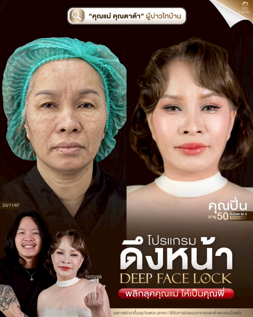 รีวิวคลินิกเสริมความงามขอนแก่นที่ UD Clinic Khonkaen