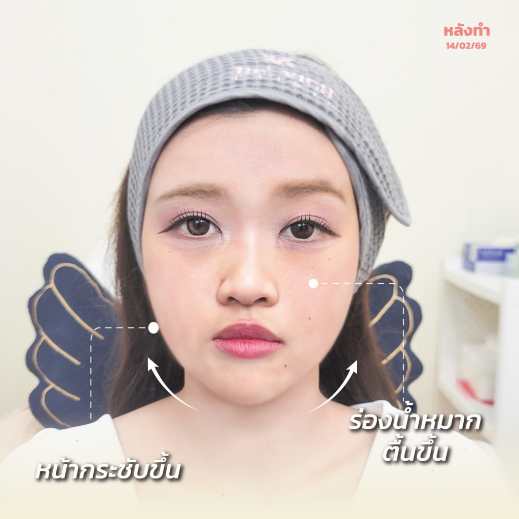 รีวิวคลินิกเสริมความงามขอนแก่นที่ เดอวิชญ์ คลินิก