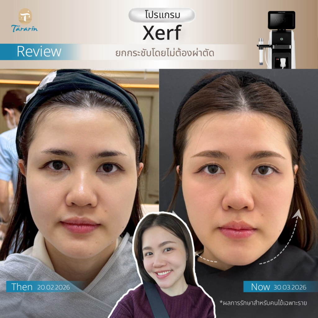 รีวิวคลินิกเสริมความงามขอนแก่นที่ ธารารินคลินิก