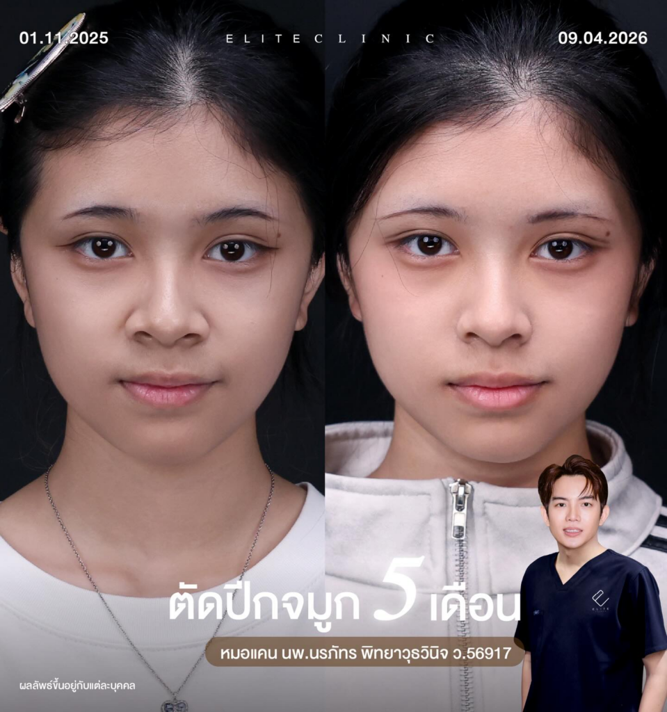 รีวิวคลินิกเสริมความงามขอนแก่นที่ Elite Clinic